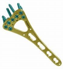 Фиксирование плиты трещиноватости ключицы Accumed ключицы крюка плеча дистальное